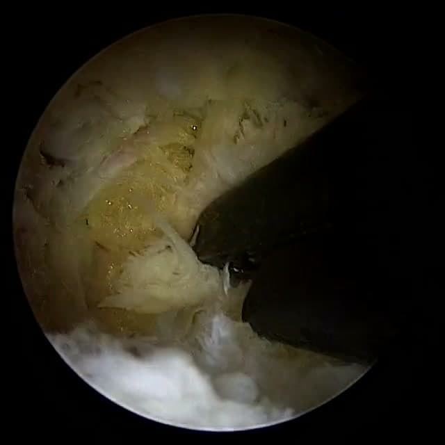 Endoscopic operative field