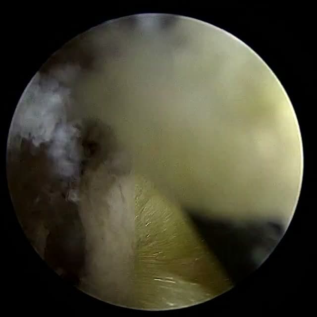Endoscopic operative field