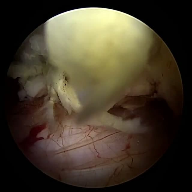 Endoscopic operative field