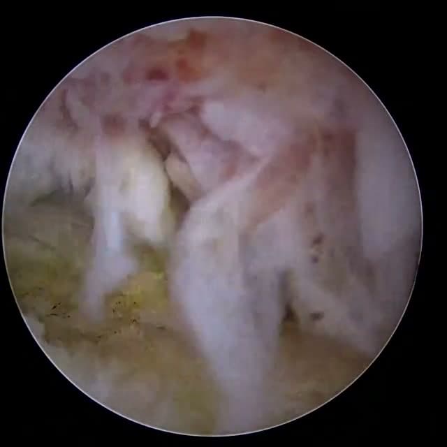 Endoscopic operative field