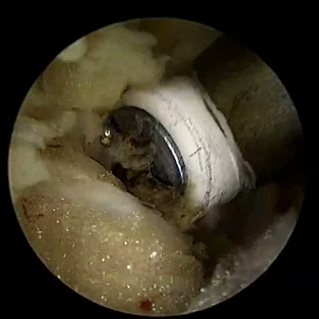 Endoscopic operative field