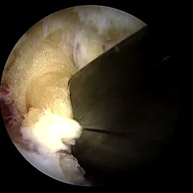 Endoscopic operative field
