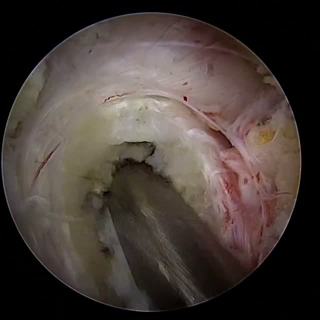 Endoscopic operative field