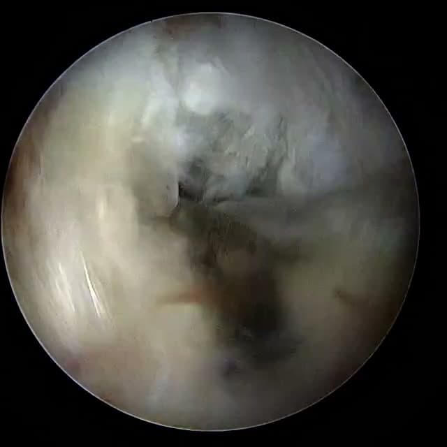 Endoscopic operative field