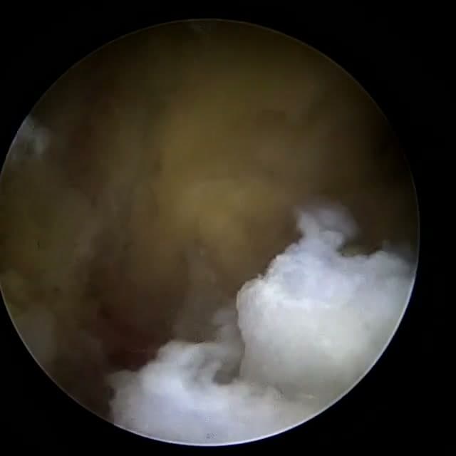 Endoscopic operative field