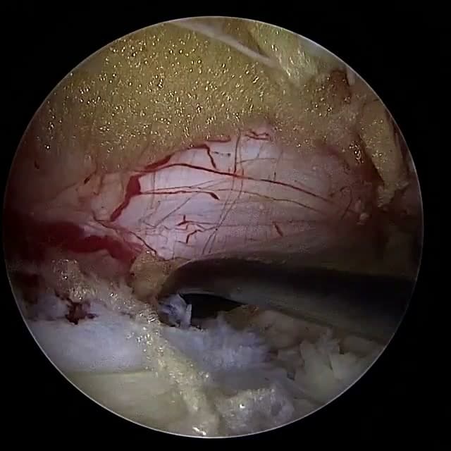 Endoscopic operative field