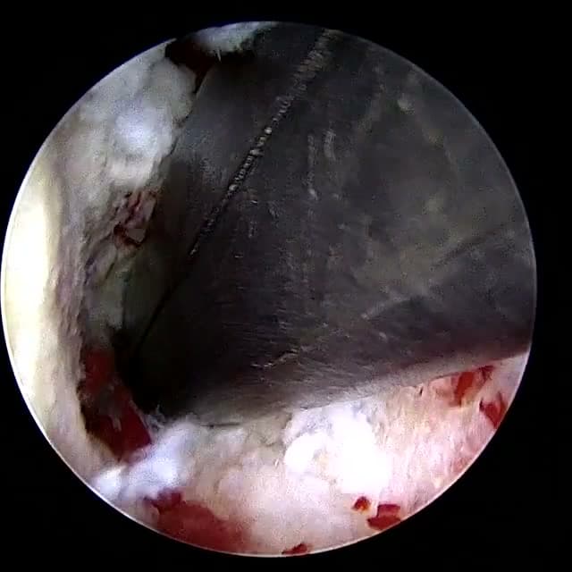 Endoscopic operative field