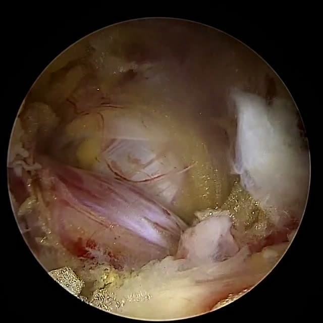 Endoscopic operative field