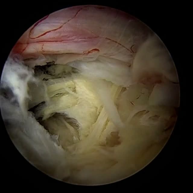 Endoscopic operative field
