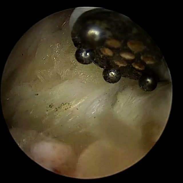 Endoscopic operative field