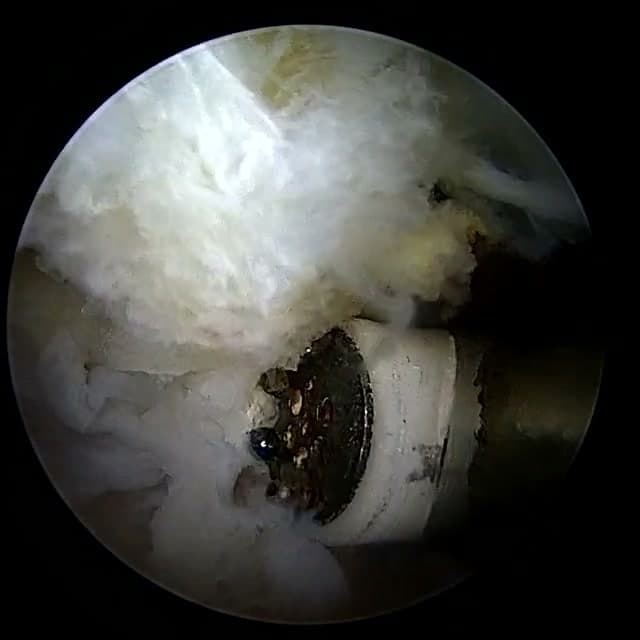 Endoscopic operative field
