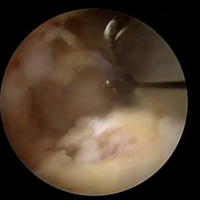 Endoscopic operative field