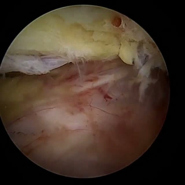 Endoscopic operative field