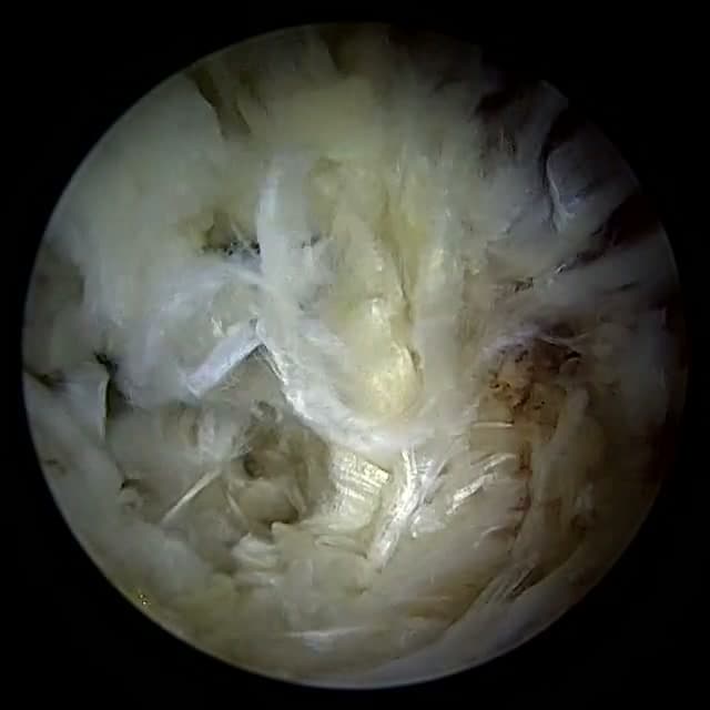Endoscopic operative field