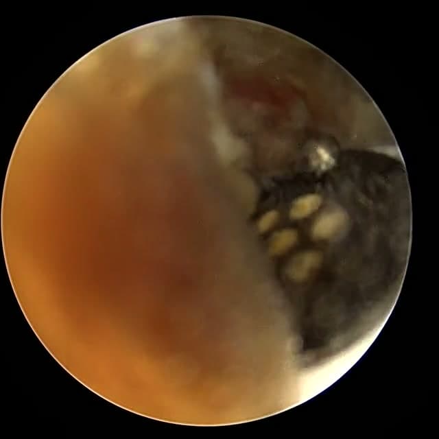 Endoscopic operative field