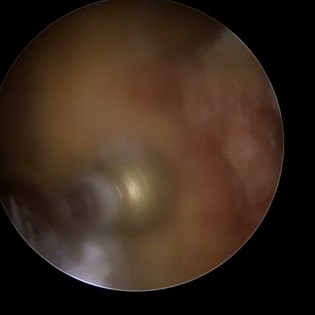 Endoscopic operative field