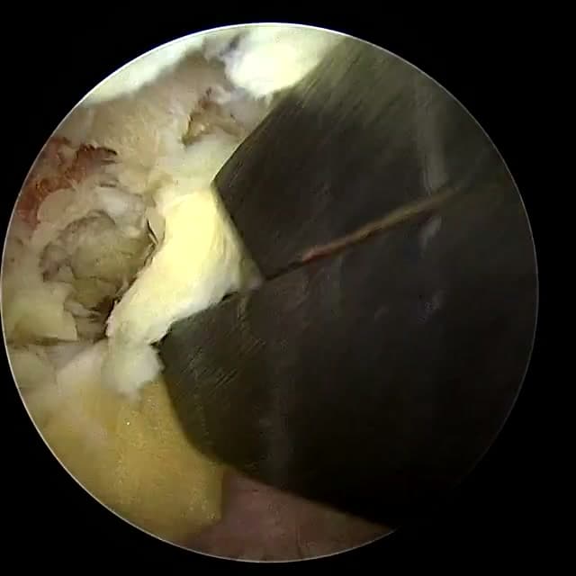 Endoscopic operative field
