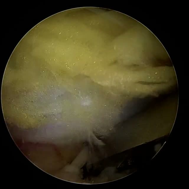 Endoscopic operative field