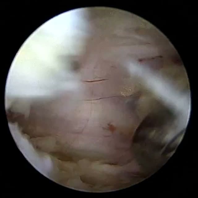 Endoscopic operative field