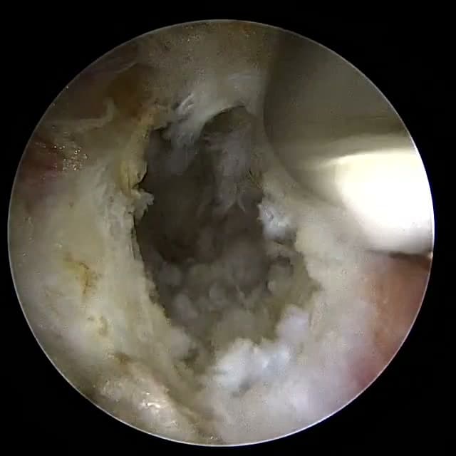 Endoscopic operative field