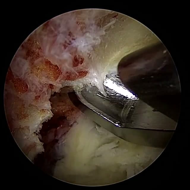 Endoscopic operative field