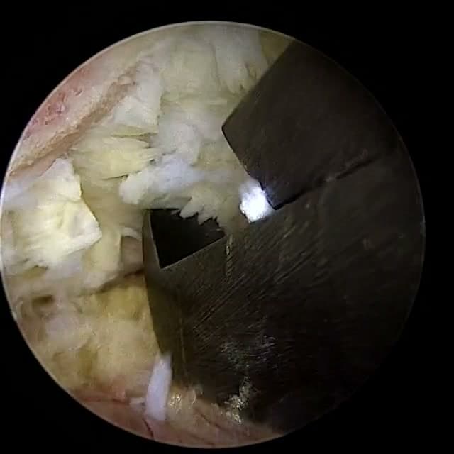 Endoscopic operative field