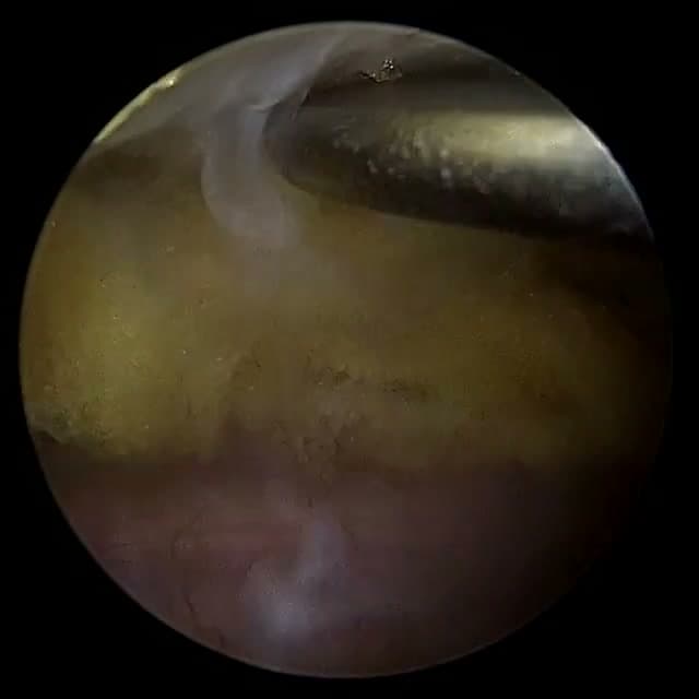 Endoscopic operative field