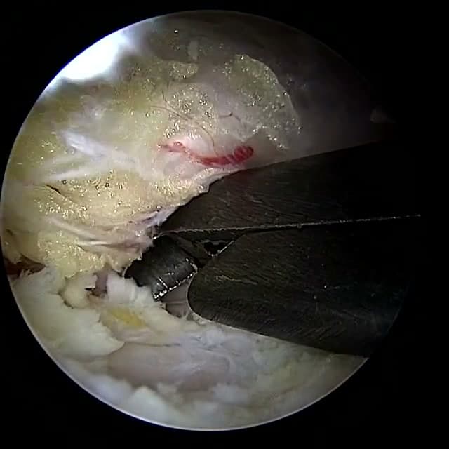 Endoscopic operative field