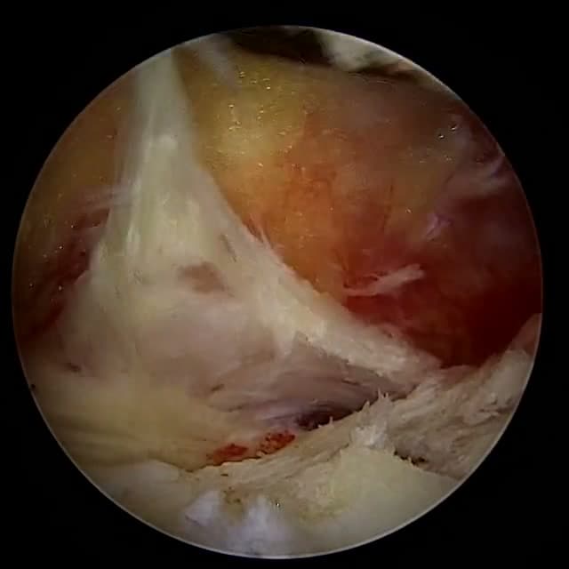 Endoscopic operative field