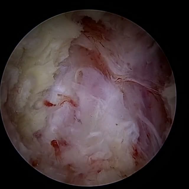 Endoscopic operative field