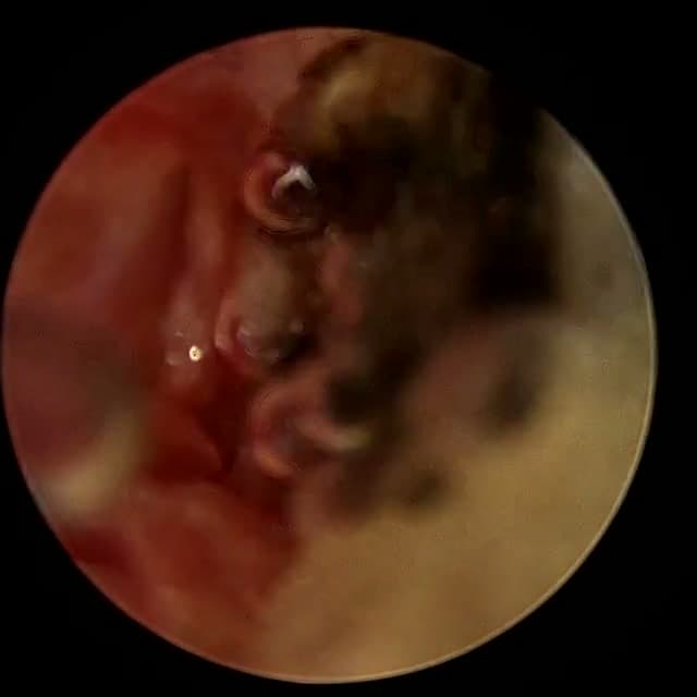 Endoscopic operative field