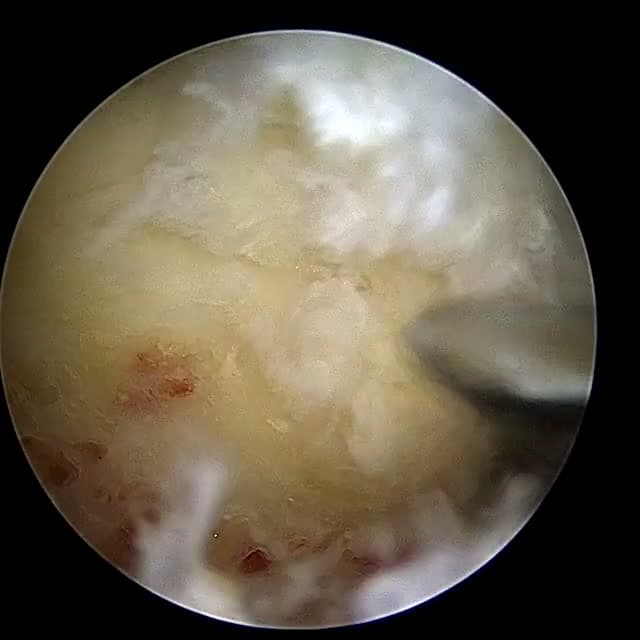 Endoscopic operative field