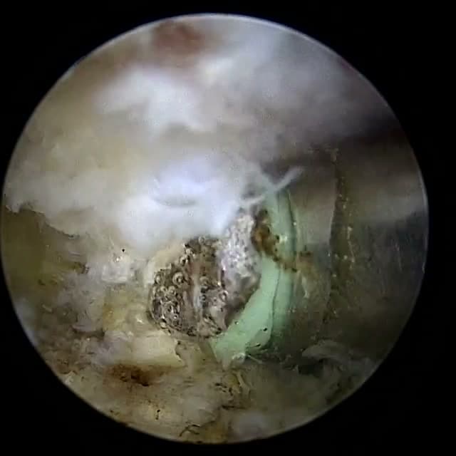 Endoscopic operative field
