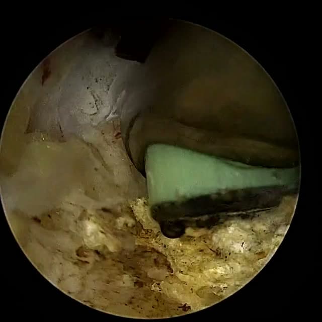 Endoscopic operative field