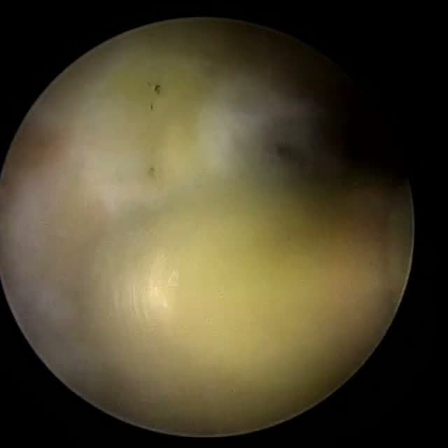 Endoscopic operative field