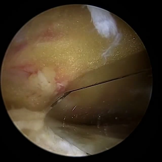 Endoscopic operative field