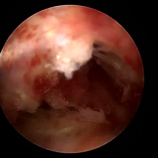 Endoscopic operative field