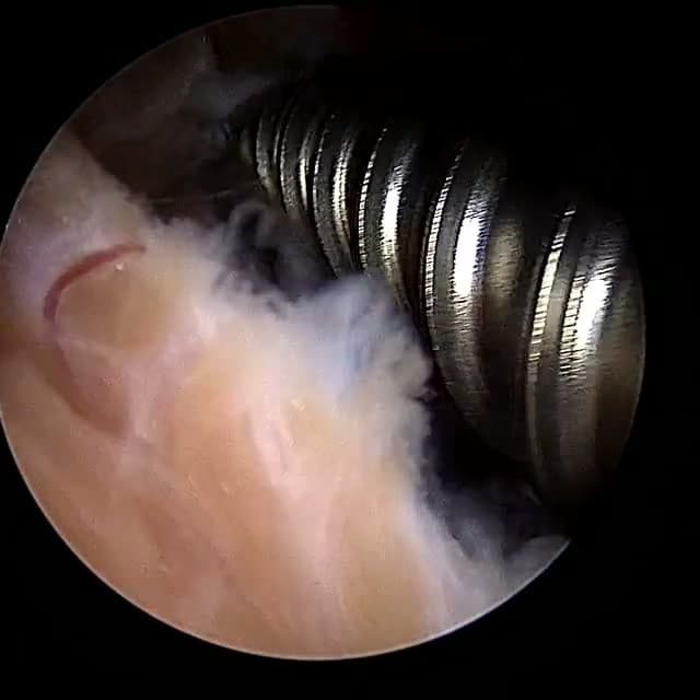 Endoscopic operative field
