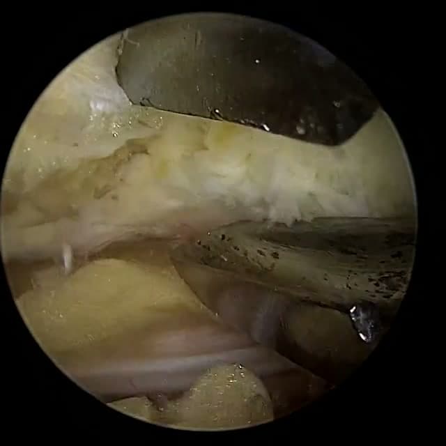 Endoscopic operative field
