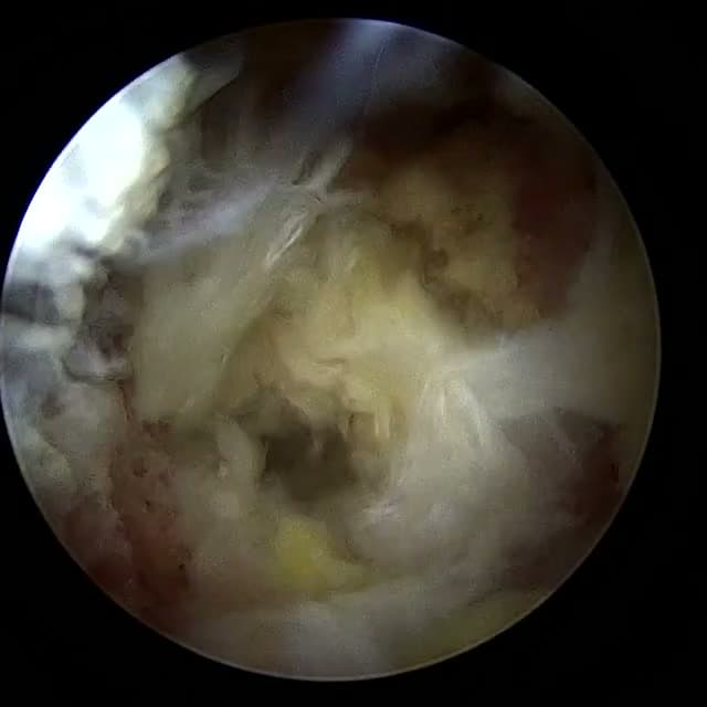Endoscopic operative field