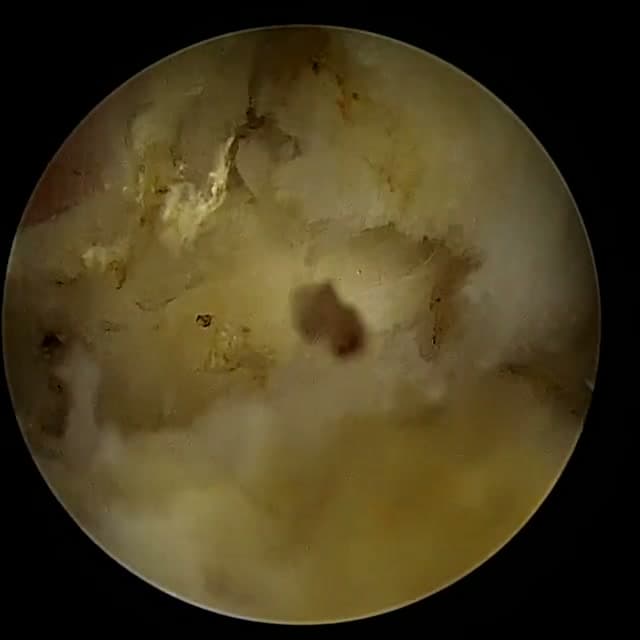 Endoscopic operative field