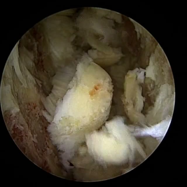 Endoscopic operative field