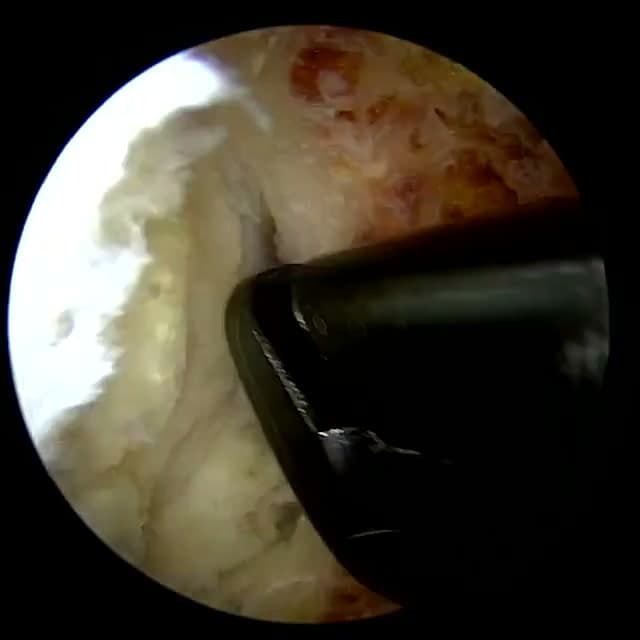 Endoscopic operative field