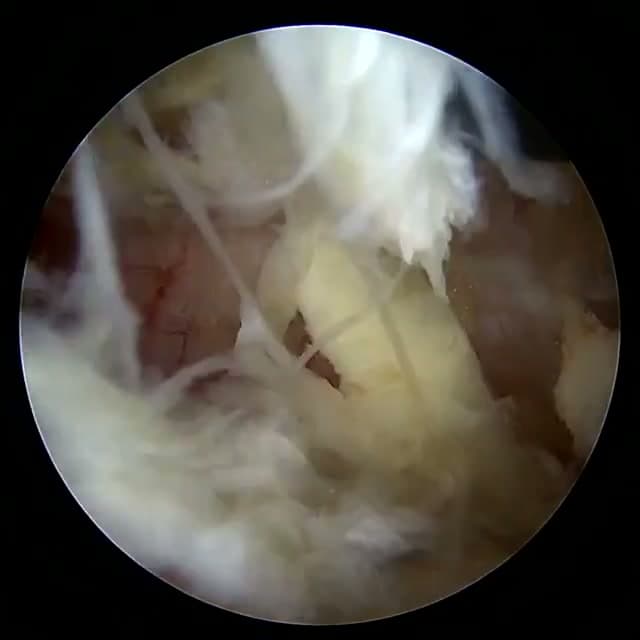 Endoscopic operative field
