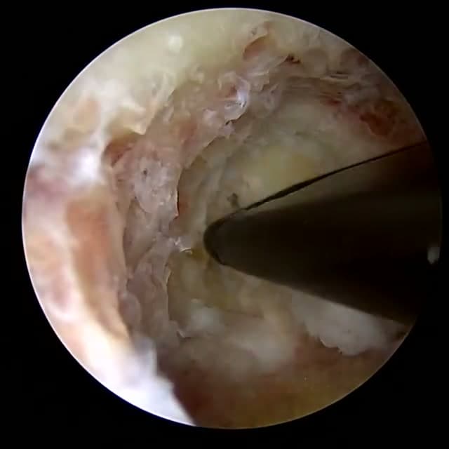 Endoscopic operative field