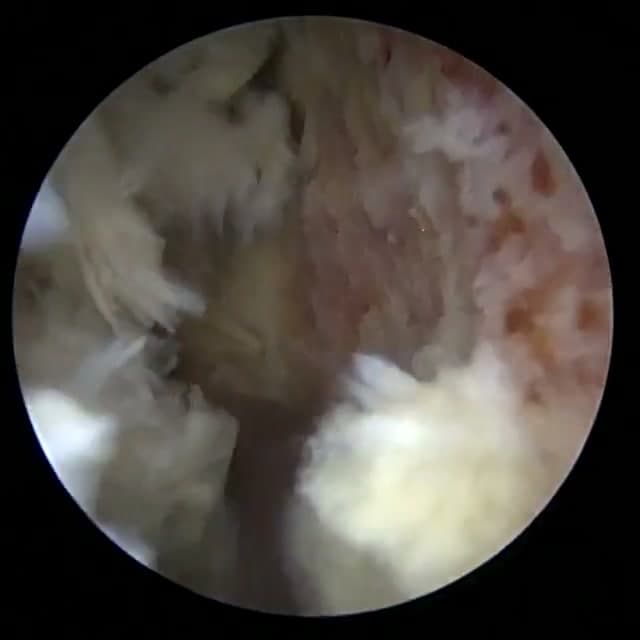 Endoscopic operative field