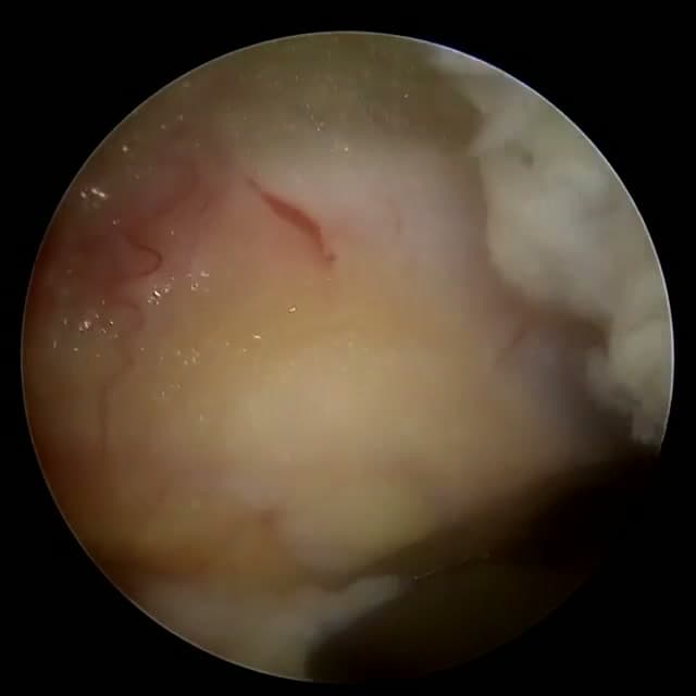 Endoscopic operative field