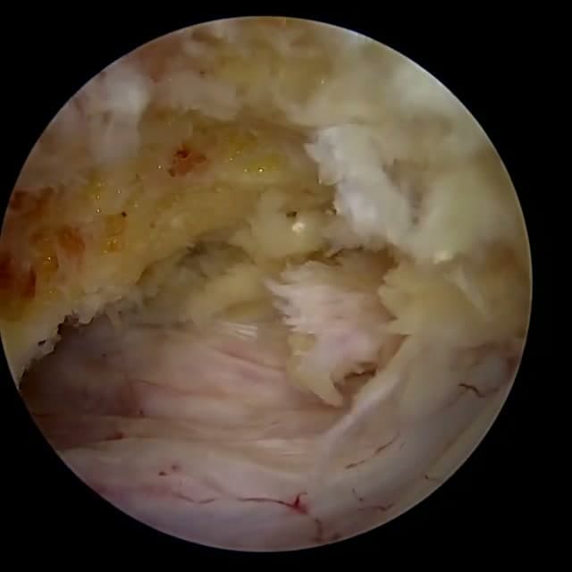Endoscopic operative field