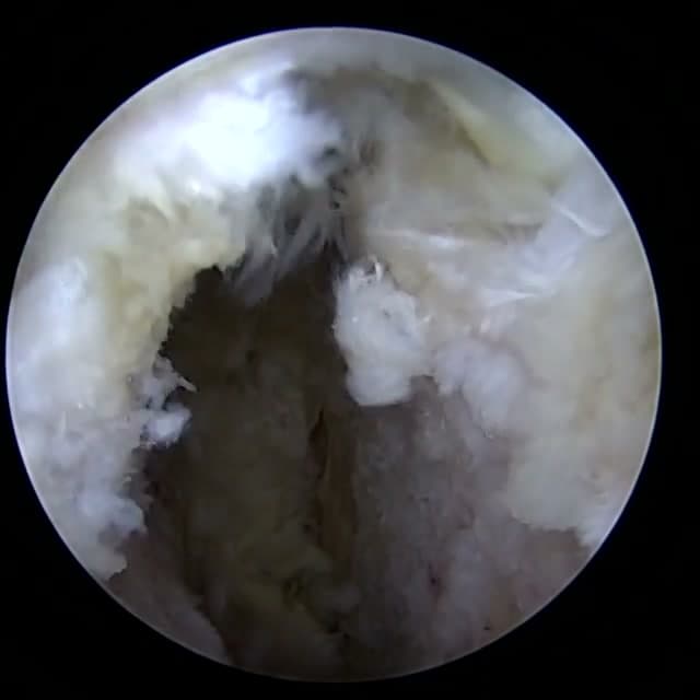 Endoscopic operative field