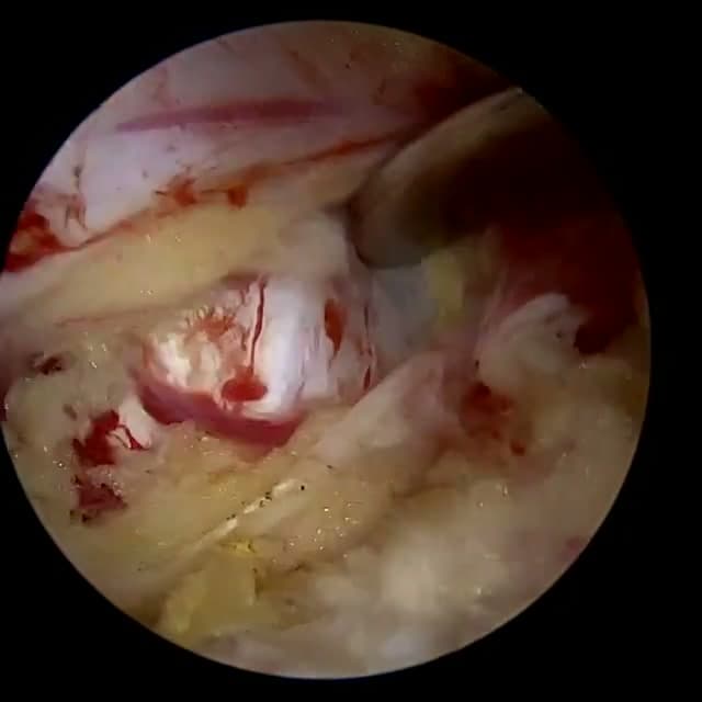 Endoscopic operative field